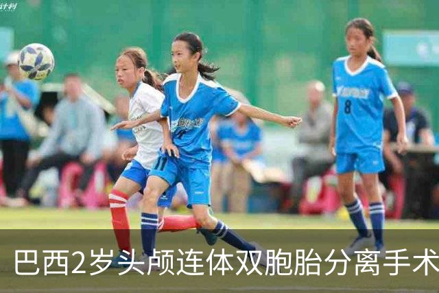 巴西2岁头颅连体双胞胎分离手术后去世